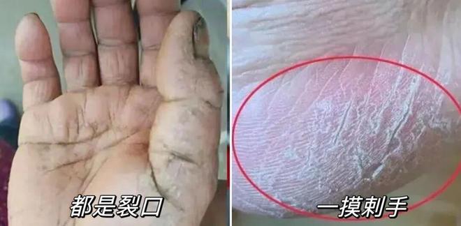 试这个外抹的方子一试就灵OG网站手足干裂的人试(图18)