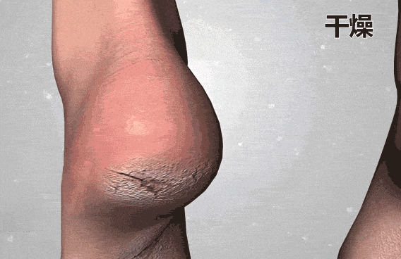 试这个外抹的方子一试就灵OG网站手足干裂的人试(图22)